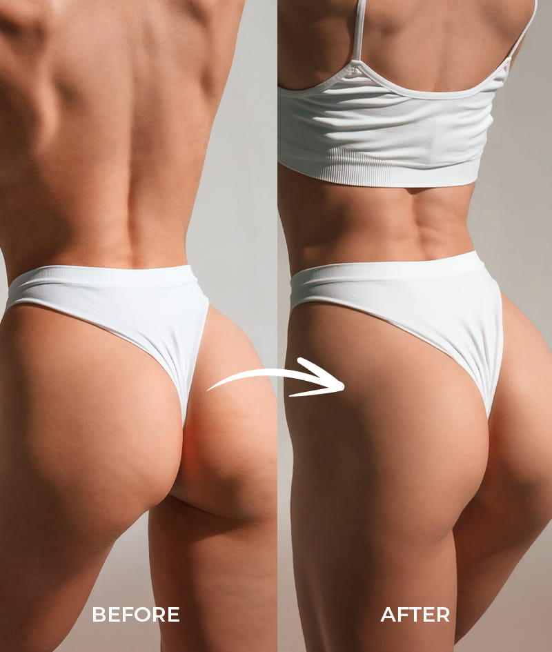COCOSOLIS SET ANTI-CELLULITE THERAPY